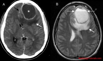 brainabscess